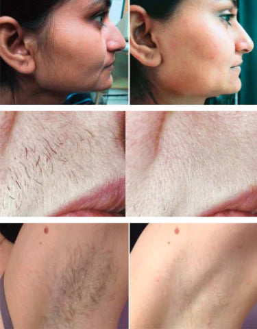 LumySkin - Depilador Facial Elétrico e Portátil [PELE LISA EM SEGUNDOS]